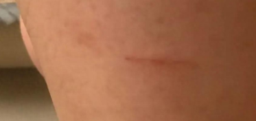 猫抓伤的轻微图（小猫抓破了皮渗了点血）