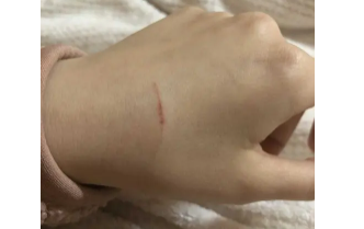 被猫抓了一下轻微破皮要打针吗多少钱（被猫抓了一下轻微破皮要打针吗需要多少钱）