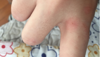 被猫抓了一下轻微破皮要打针吗多久去打针（被猫抓了一下轻微破皮需要打几针）