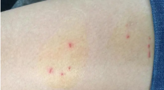 被猫抓了一下轻微破皮要打针吗猫打了疫苗（被猫抓了一下轻微破皮要打针吗 猫打过疫苗）