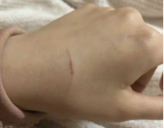 被猫抓了一下轻微划痕要打针吗（被猫抓了一下轻微划痕要打针吗没出血）