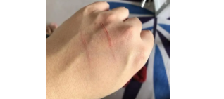 被猫咬一下轻微破皮要打针吗没出血（被猫咬了一下轻微破皮出点血要打预防针吗）