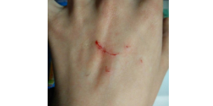 被猫抓了一下过了24小时还可以打针吗（被猫抓了一下过了10天了怎么办）