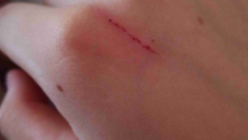 小猫抓伤了一点出血需要打针吗（被猫咬了一口出血了需要打针吗）