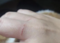 被猫抓了一下轻微破皮要打针吗多久去打针（被猫抓了一下轻微破皮需要打几针）