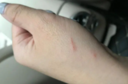 被猫抓了一下轻微破皮要打针吗以前打过狂犬疫苗（被猫抓了一下轻微破皮要打针吗之前打过疫苗）