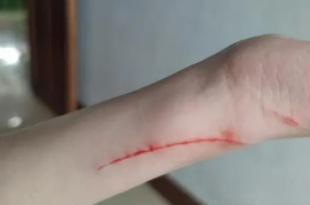 被猫抓了一下轻微破皮要打针吗多少钱（被猫抓了一下轻微破皮要打针吗）