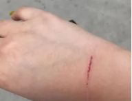 一般被猫狗咬伤狂犬病潜伏期多长时间（被猫咬狂犬病潜伏期多久）