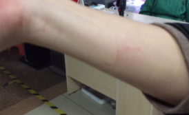 狂犬病潜伏期多长时间场达20年（狂犬病潜伏期20年?）